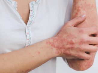 l'urticaire et l'eczéma