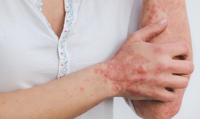 l'urticaire et l'eczéma l'urticaire et l'eczéma